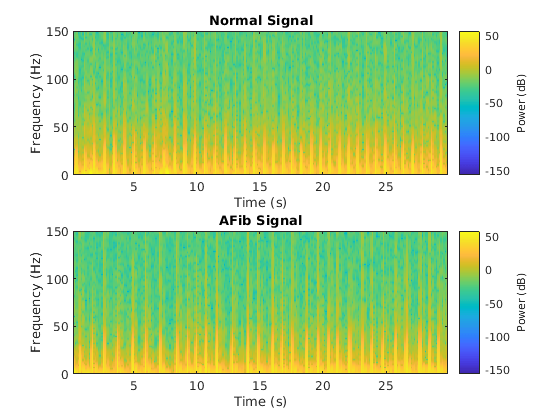 Classify ECG Signals Using Long Short-Term Memory Networks