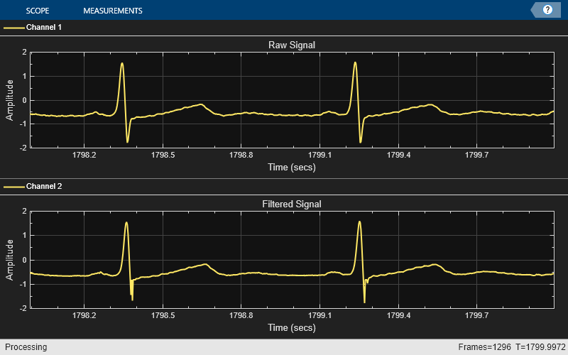 Outlier Removal Techniques with ECG Signals